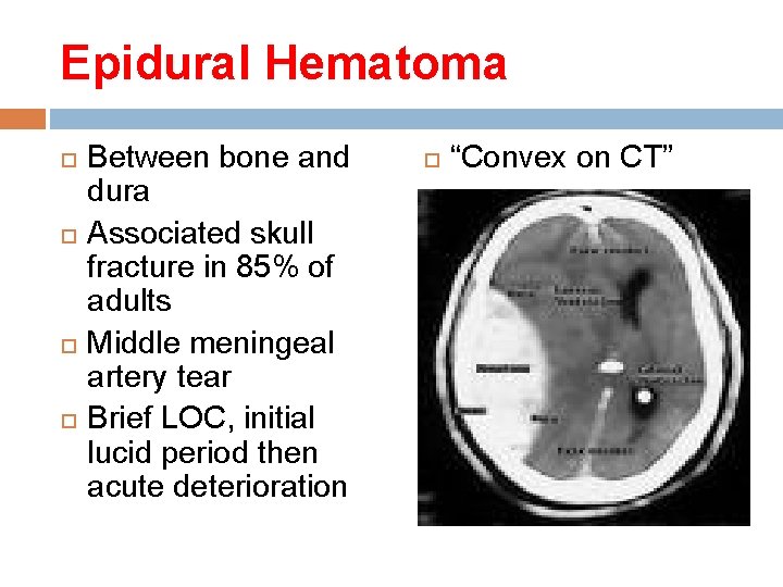 Epidural Hematoma Between bone and dura Associated skull fracture in 85% of adults Middle Epidural Hematoma Between bone and dura Associated skull fracture in 85% of adults Middle