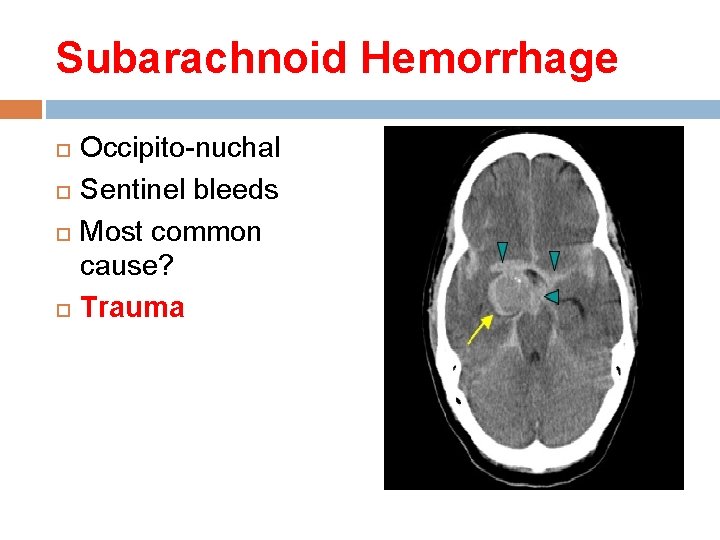 Subarachnoid Hemorrhage Occipito-nuchal Sentinel bleeds Most common cause? Trauma Subarachnoid Hemorrhage Occipito-nuchal Sentinel bleeds Most common cause? Trauma