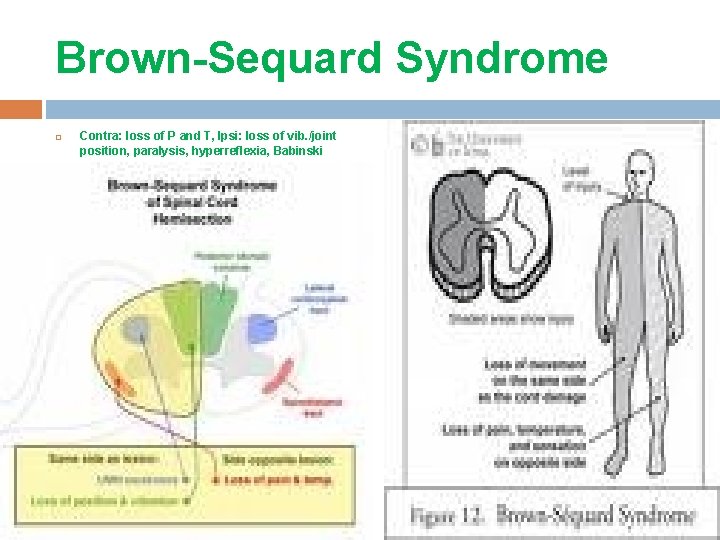 Brown-Sequard Syndrome Contra: loss of P and T, Ipsi: loss of vib. /joint position, Brown-Sequard Syndrome Contra: loss of P and T, Ipsi: loss of vib. /joint position,