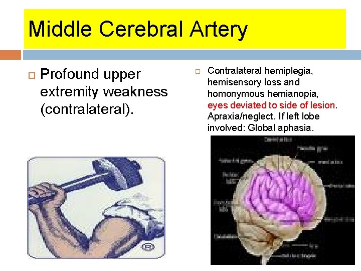 Middle Cerebral Artery Profound upper extremity weakness (contralateral). Contralateral hemiplegia, hemisensory loss and homonymous Middle Cerebral Artery Profound upper extremity weakness (contralateral). Contralateral hemiplegia, hemisensory loss and homonymous