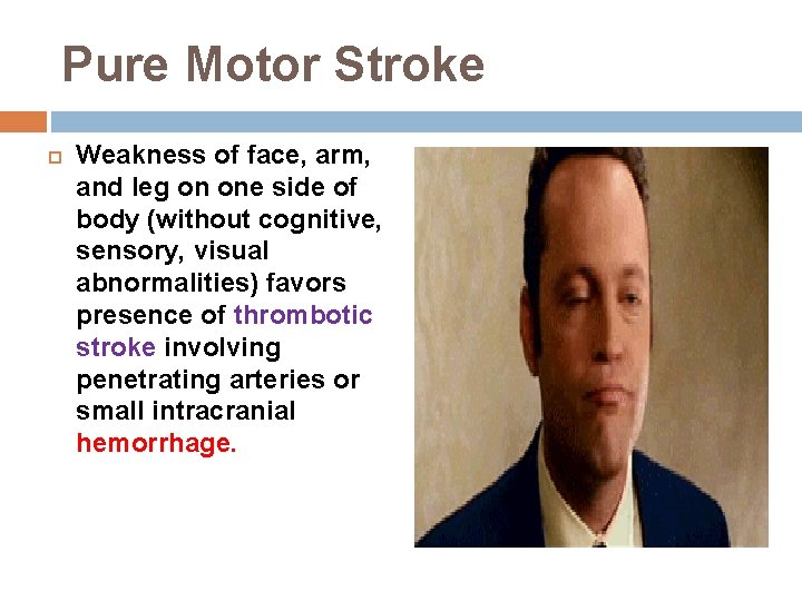 Pure Motor Stroke Weakness of face, arm, and leg on one side of body Pure Motor Stroke Weakness of face, arm, and leg on one side of body