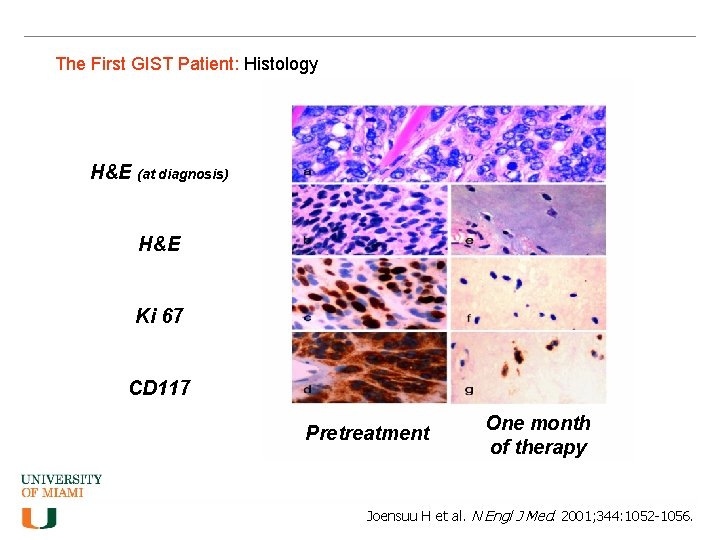 The First GIST Patient: Histology H&E (at diagnosis) H&E Ki 67 CD 117 Pretreatment