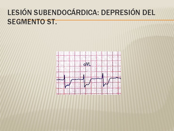 LESIÓN SUBENDOCÁRDICA: DEPRESIÓN DEL SEGMENTO ST. 