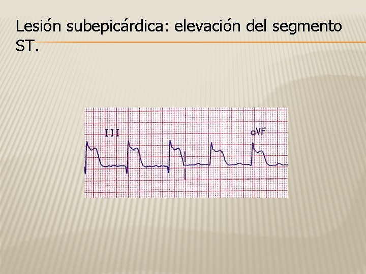 Lesión subepicárdica: elevación del segmento ST. 