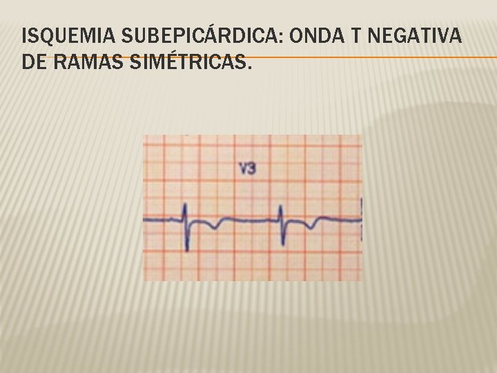 ISQUEMIA SUBEPICÁRDICA: ONDA T NEGATIVA DE RAMAS SIMÉTRICAS. 