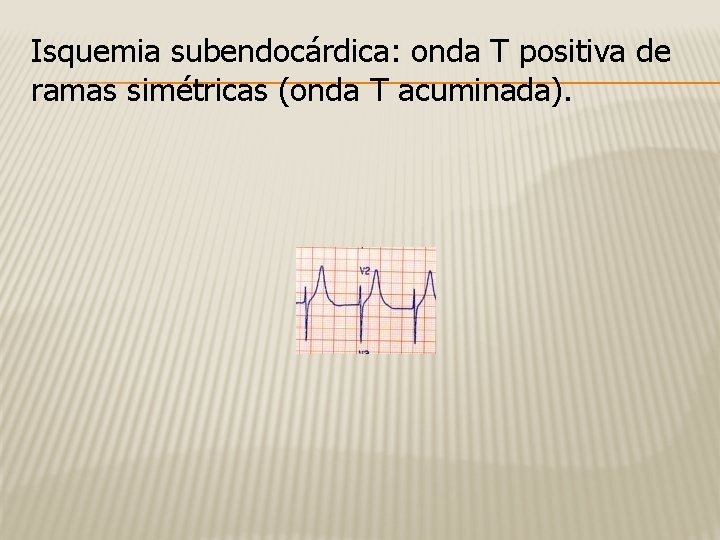 Isquemia subendocárdica: onda T positiva de ramas simétricas (onda T acuminada). 