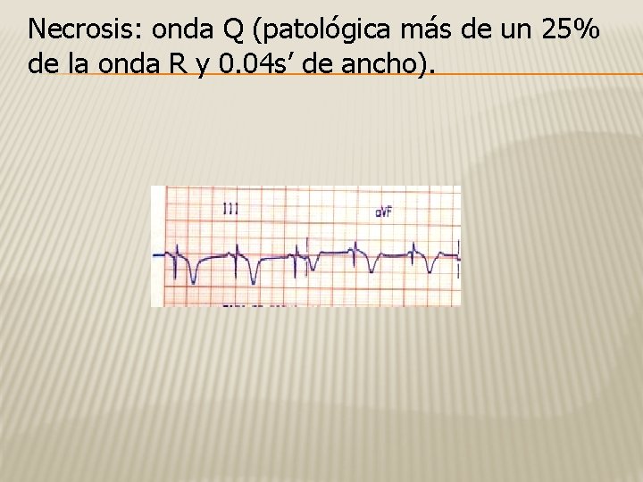 Necrosis: onda Q (patológica más de un 25% de la onda R y 0.