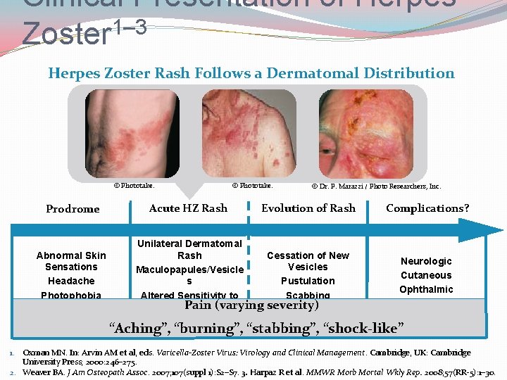 Clinical Presentation of Herpes Zoster 1– 3 Herpes Zoster Rash Follows a Dermatomal Distribution