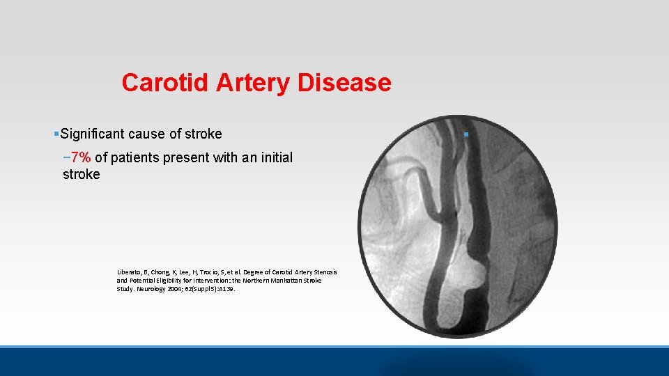 Carotid Artery Disease § Significant cause of stroke − 7% of patients present with Carotid Artery Disease § Significant cause of stroke − 7% of patients present with