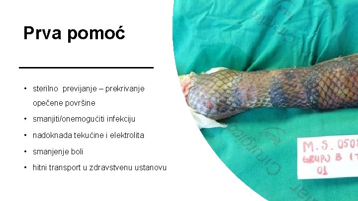 Prva pomoć • sterilno previjanje – prekrivanje opečene površine • smanjiti/onemogućiti infekciju • nadoknada