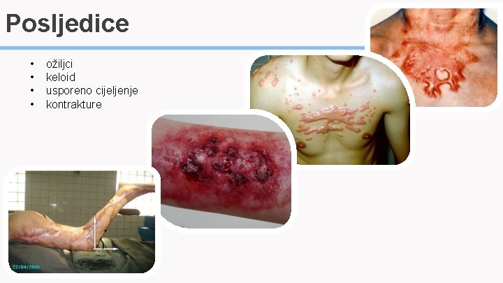 Posljedice • • ožiljci keloid usporeno cijeljenje kontrakture 