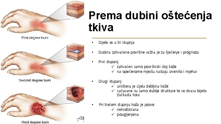 Prema dubini oštećenja tkiva • Dijele se u tri stupnja • Dubina zahvaćene površine