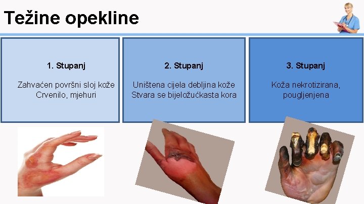 Težine opekline 1. Stupanj 2. Stupanj 3. Stupanj Zahvaćen površni sloj kože Crvenilo, mjehuri