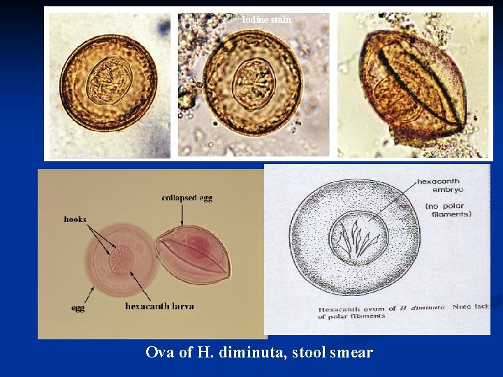 Iodine stain Ova of H. diminuta, stool smear 201 