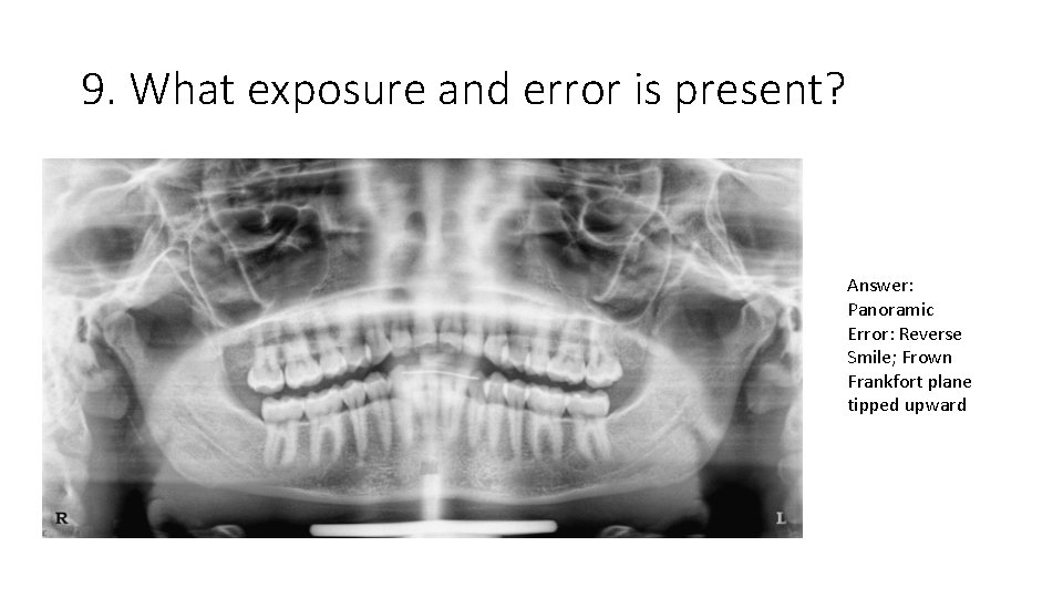 9. What exposure and error is present? Answer: Panoramic Error: Reverse Smile; Frown Frankfort