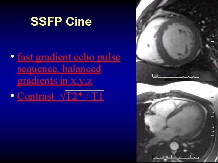 SSFP Cine • fast gradient echo pulse sequence, balanced gradients in x, y, z