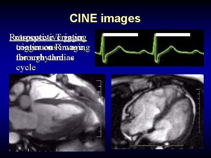 CINE images Retrospective gating Prospective Trigger continuous trigger on Rimaging wave, through cardiac for