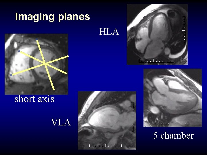 Imaging planes HLA short axis VLA 5 chamber 