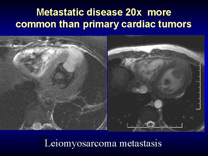Metastatic disease 20 x more common than primary cardiac tumors T 2 Leiomyosarcoma metastasis