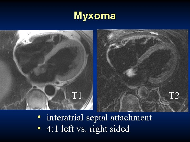 Myxoma T 1 • interatrial septal attachment • 4: 1 left vs. right sided