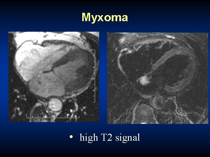 Myxoma • high T 2 signal 