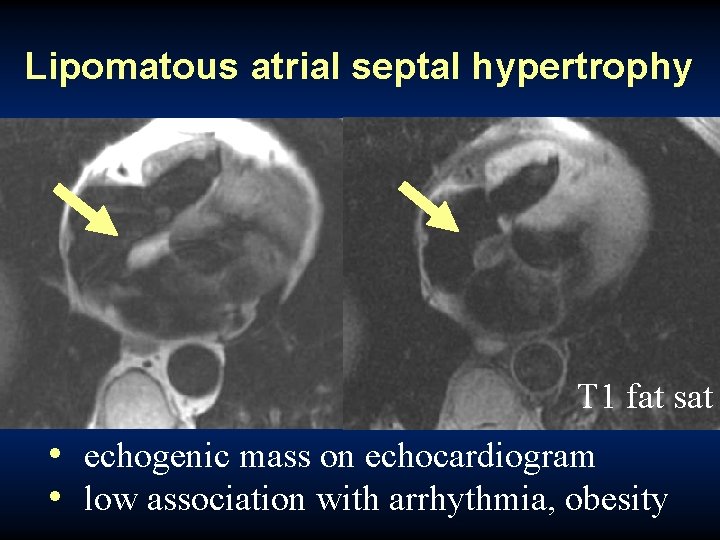 Lipomatous atrial septal hypertrophy T 1 fat sat • echogenic mass on echocardiogram •