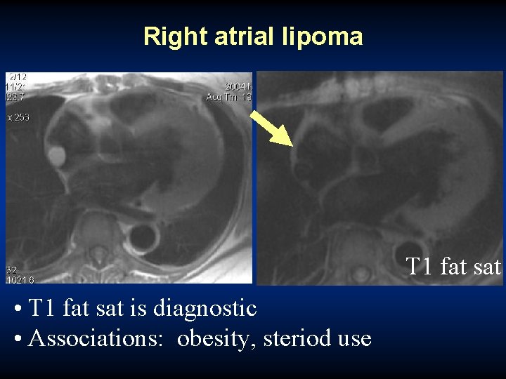 Right atrial lipoma T 1 fat sat • • T 1 High fat T