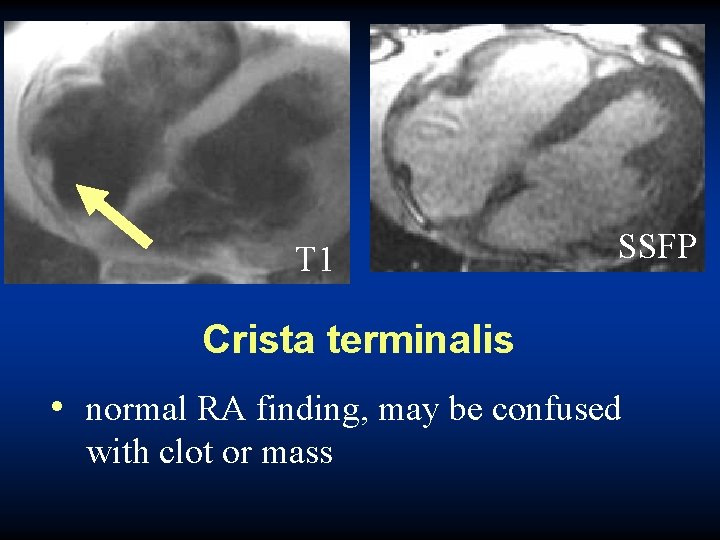 T 1 SSFP Crista terminalis • normal RA finding, may be confused with clot