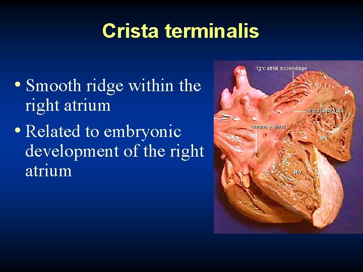 Crista terminalis • Smooth ridge within the right atrium • Related to embryonic development