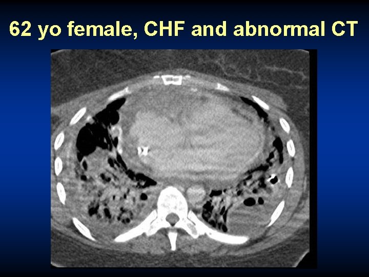 62 yo female, CHF and abnormal CT 