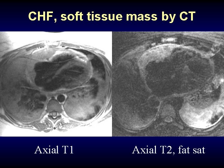 CHF, soft tissue mass by CT Axial T 1 Axial T 2, fat sat