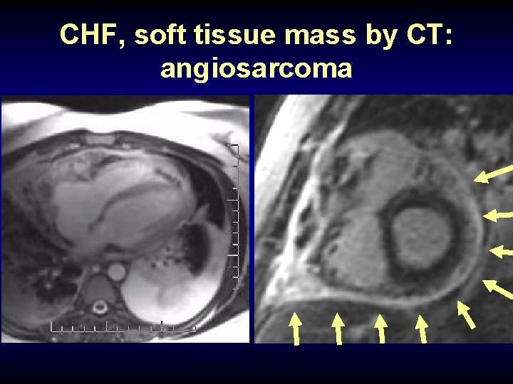 CHF, soft tissue mass by CT: angiosarcoma 