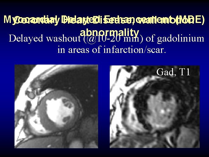 Myocardial Enhancement (MDE) Coronary Delayed Heart Disease, wall motion abnormality Delayed washout (@10 -20