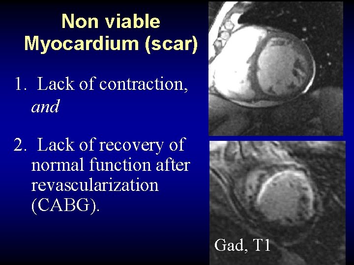 Non viable Myocardium (scar) 1. Lack of contraction, and 2. Lack of recovery of