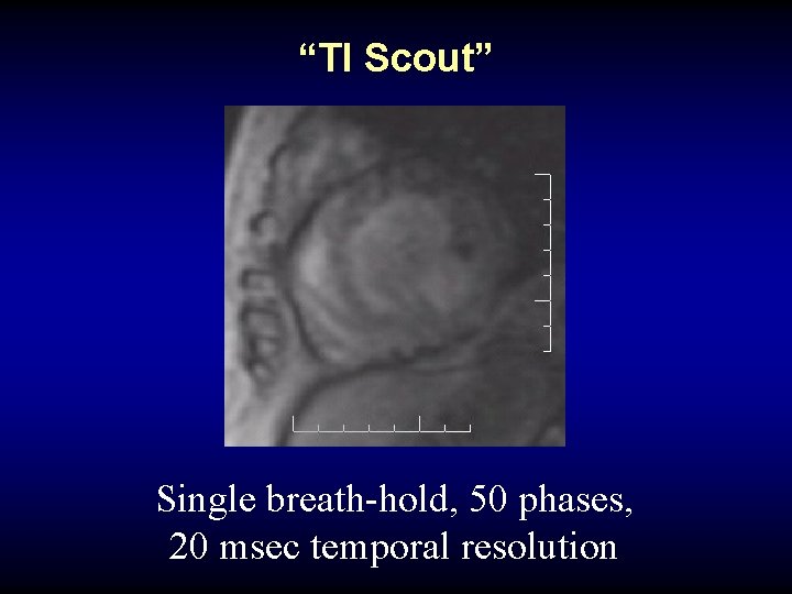 “TI Scout” Single breath-hold, 50 phases, 20 msec temporal resolution 