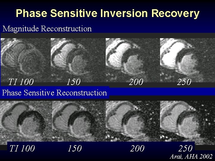 Phase Sensitive Inversion Recovery Magnitude Reconstruction TI 100 150 200 250 Phase Sensitive Reconstruction