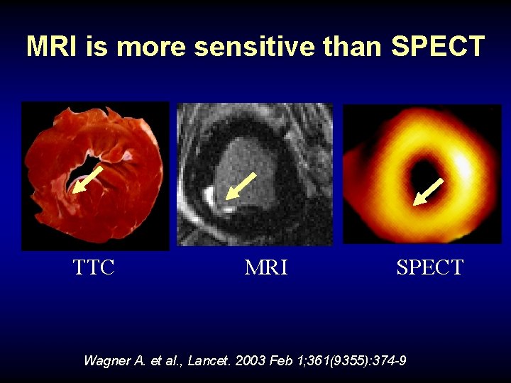 MRI is more sensitive than SPECT TTC MRI SPECT Wagner A. et al. ,