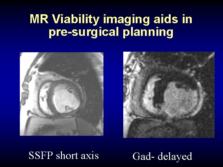 MR Viability imaging aids in pre-surgical planning SSFP short axis Gad- delayed 