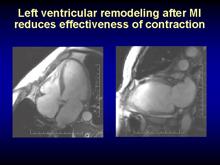 Left ventricular remodeling after MI reduces effectiveness of contraction 