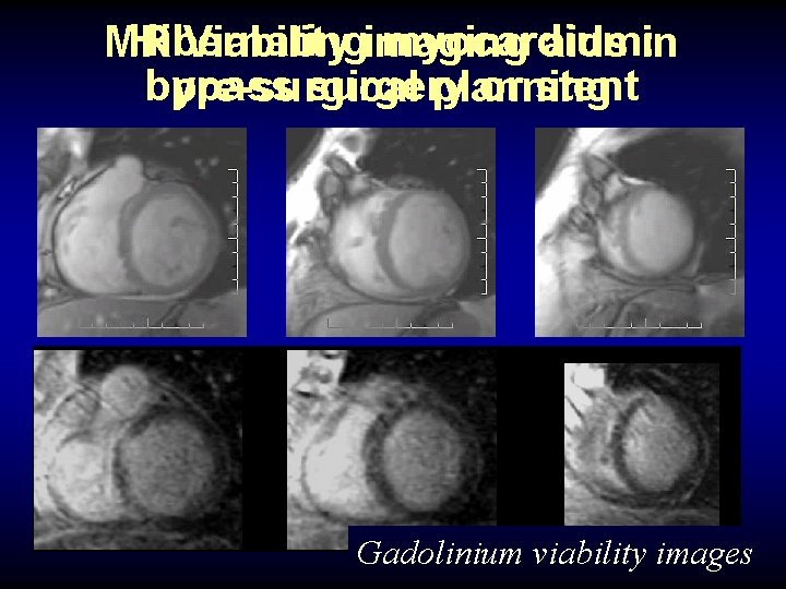 Hibernating myocardium: MR Viability imaging aids in bypass surgery or stent pre-surgical planning Gadolinium