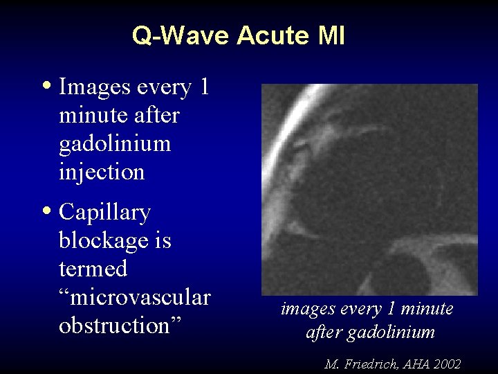 Q-Wave Acute MI • Images every 1 minute after gadolinium injection • Capillary blockage