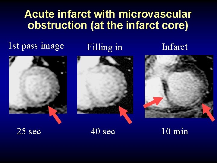 Acute infarct with microvascular obstruction (at the infarct core) 1 st pass image 25