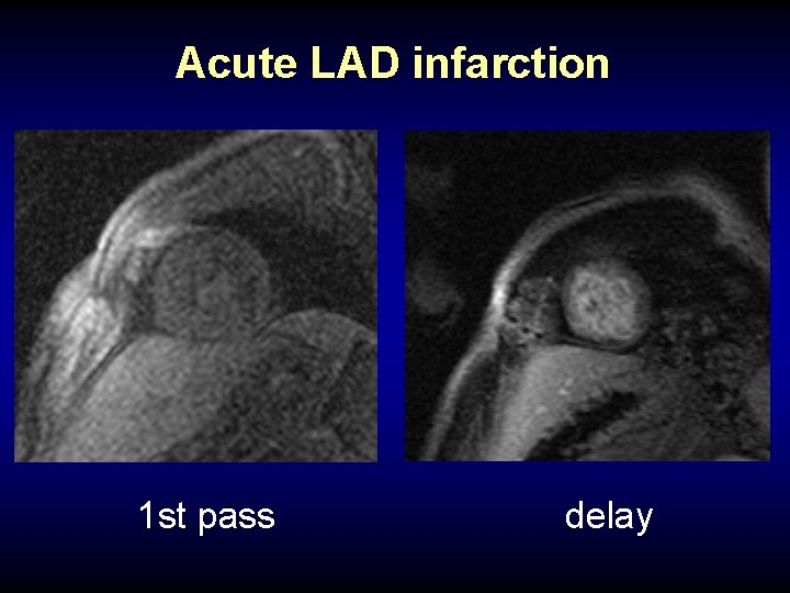 Acute LAD infarction 1 st pass delay 