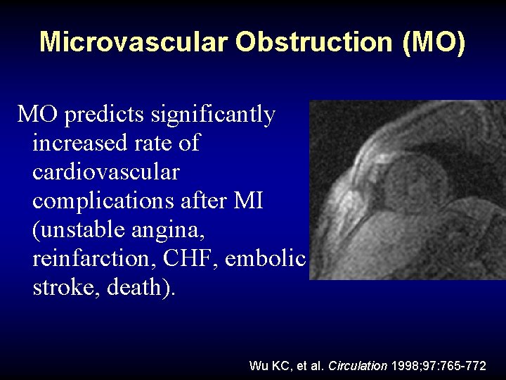 Microvascular Obstruction (MO) MO predicts significantly increased rate of cardiovascular complications after MI (unstable