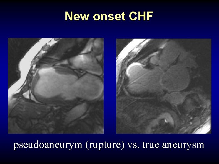 New onset CHF pseudoaneurym (rupture) vs. true aneurysm 