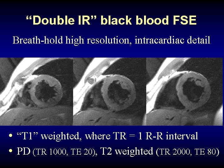 “Double IR” black blood FSE Breath-hold high resolution, intracardiac detail • “T 1” weighted,