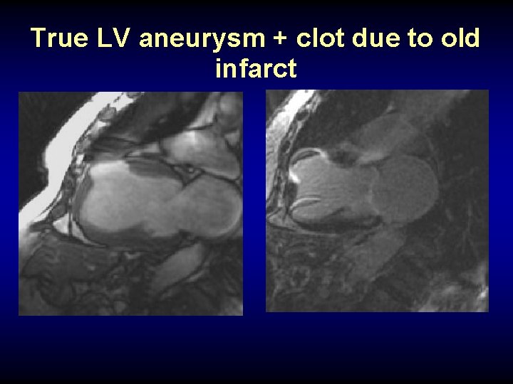 True LV aneurysm + clot due to old infarct 