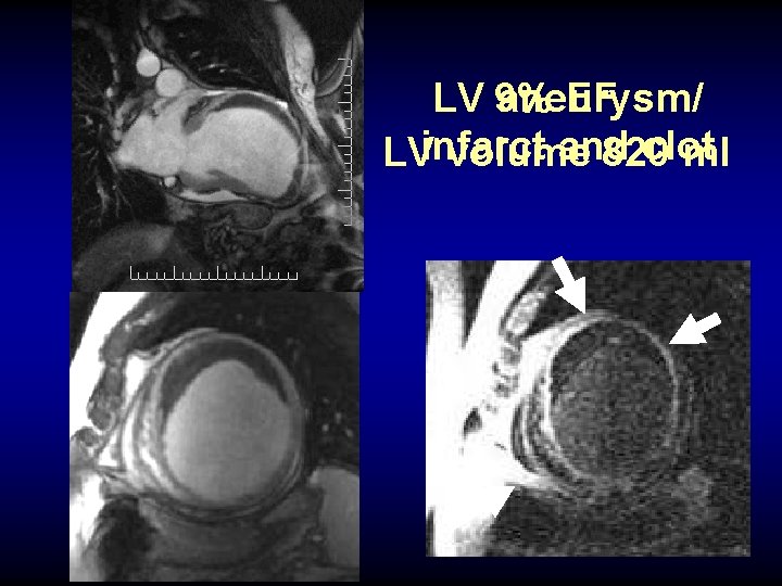 EF LV 9% aneurysm/ and clot LVinfarct volume 820 ml 