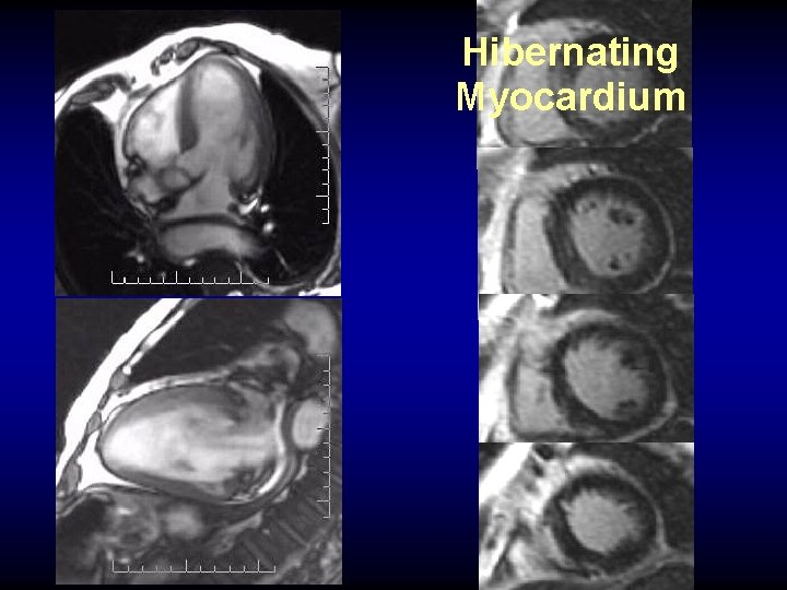 Hibernating Myocardium 16%EF 