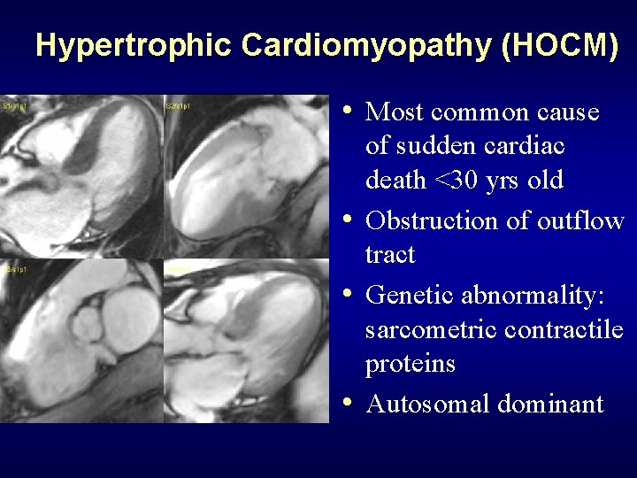 Hypertrophic Cardiomyopathy (HOCM) • Most common cause of sudden cardiac death <30 yrs old